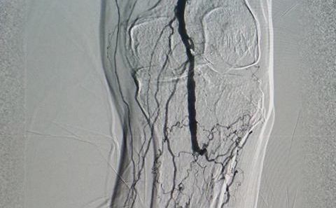 Bung dù thông liên nhĩ và can thiệp mở tắc gây hẹp động mạch chi bằng máy DSA (Ảnh: Bội Nhiên)