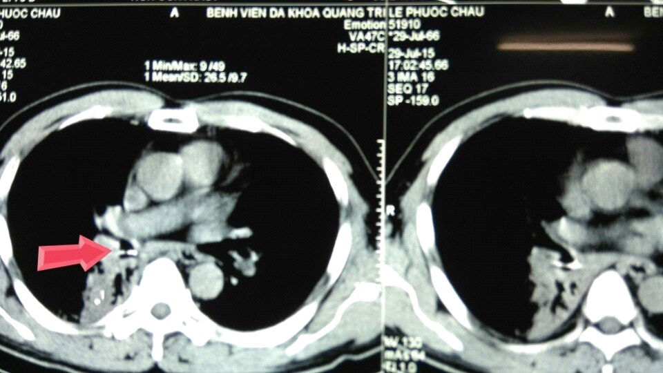ảnh dị vật đường thở