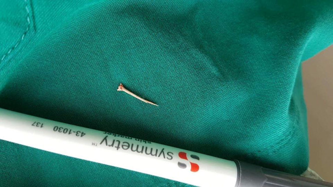 Mẫu xương cá dài 1,5 cm sau khi được lấy ra