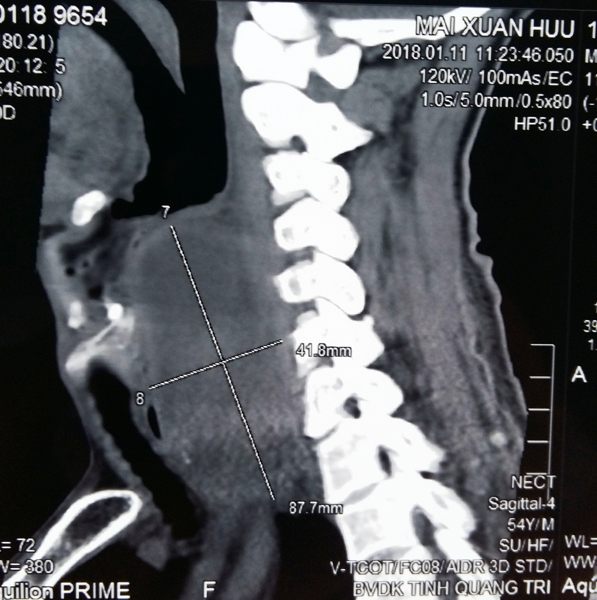 Khối áp-xe lớn (vùng có dấu chữ thập) ngoài thực quản ông Mai Xuân Hữu