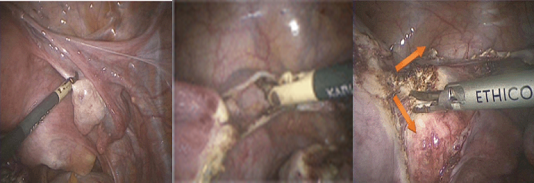 Phẫu thuật cắt tử cung toàn phần qua nội soi