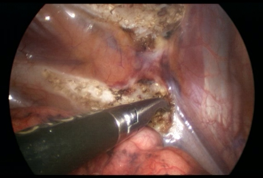 giaiphaulongnguc3 jpg gif