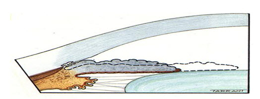 Cơ chế đóng góc trong hội chứng mống mắt phẳng