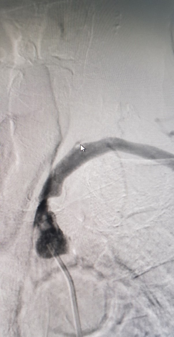 Hình ảnh can thiệp động mạch dưới đòn tại Bệnh viện Đa khoa Tỉnh Quảng Trị