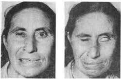 Hình: Triệu chứng liệt VII ngoại biên [6]