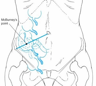 vị trí ruột thừa trong ổ bụng
