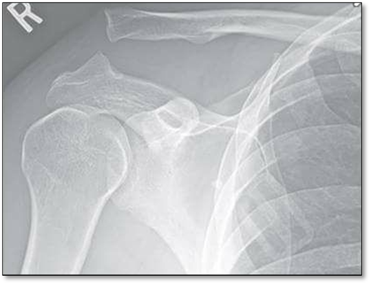 Hình ảnh trật khớp trên Xquang