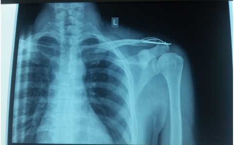 Hình ảnh kết hợp xương khớp cùng đòn bằng đinh và chỉ thép