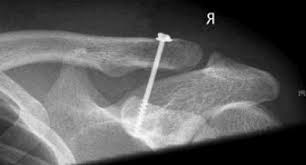 Hình ảnh kết hợp xương khớp cùng đòn bằng vít quạ - đòn