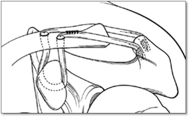 Hình ảnh tái tạo dây chằng quạ đòn bằng gân tự thân