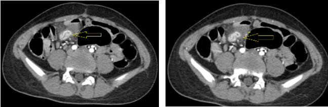 Hình ảnh CT scan ổ bụng