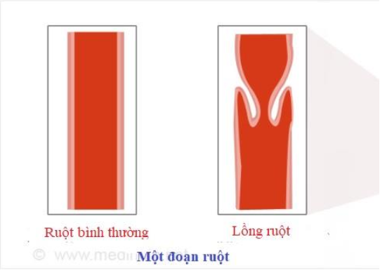 Hình 1. Hình ảnh lồng ruột