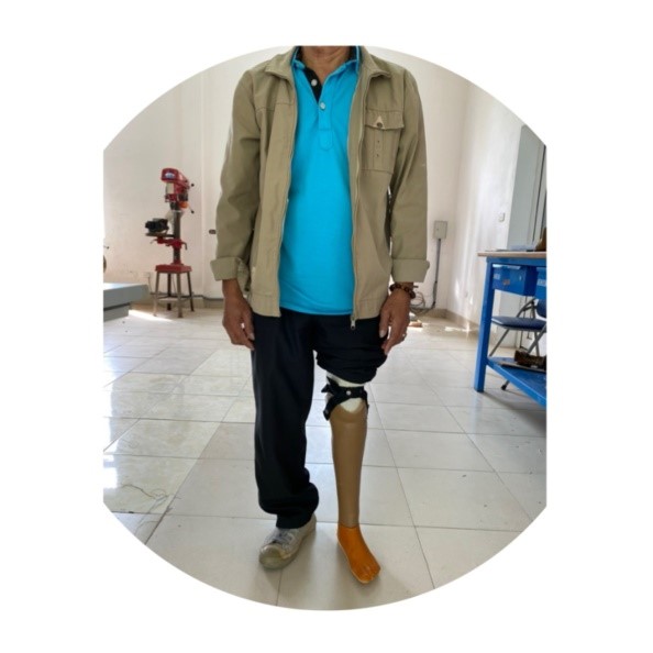 Chân giả dưới gối 2