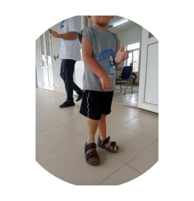 Chân giả dưới gối