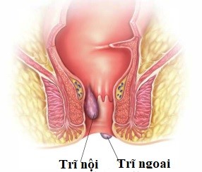 Hình 1 Phân loại trĩ theo giải phẫu