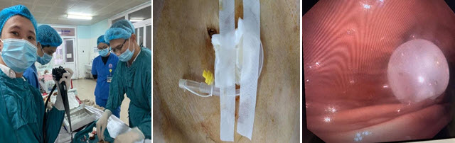 Hình ảnh mở thông dạ dày qua nội soi tại Khoa Thăm Dò Chức Năng Bệnh viện đa khoa tỉnh Quảng Trị