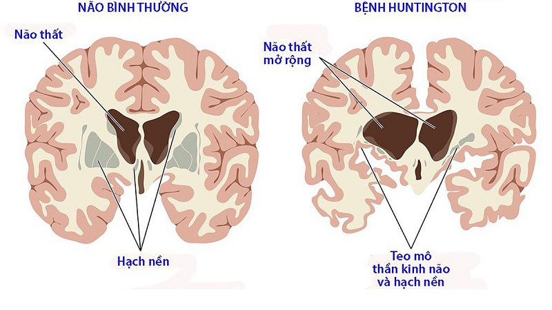 Bệnh lý Hungtington
