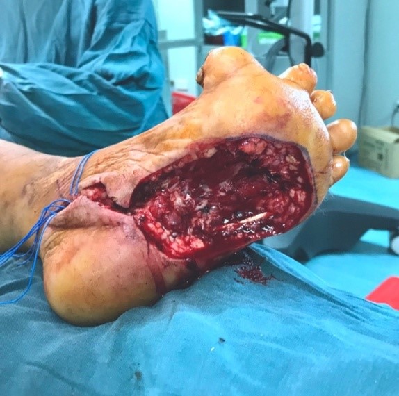 Khuyết hỏng sau khi cắt u