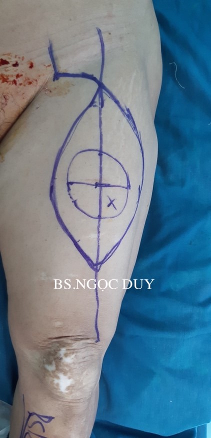 Thiết kế vạt da cân đùi trước ngoài