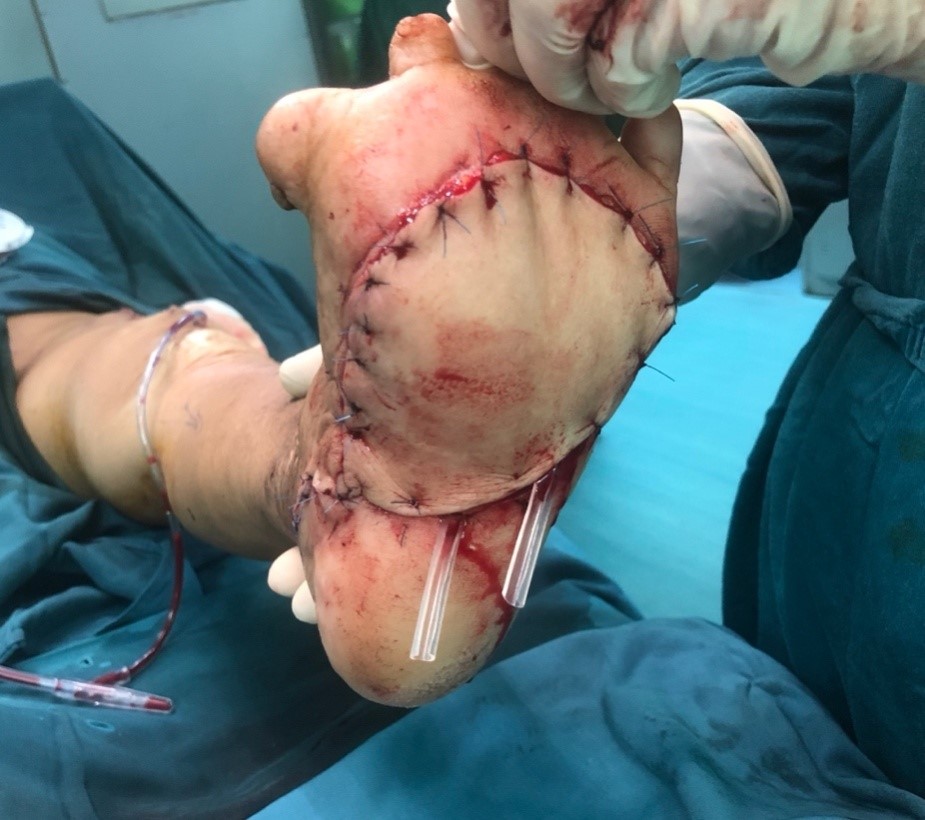 Vạt da che hoàn toàn khuyết hỏng