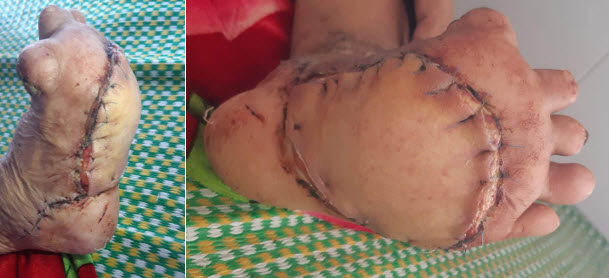 Vạt da sống tốt sau 10 ngày