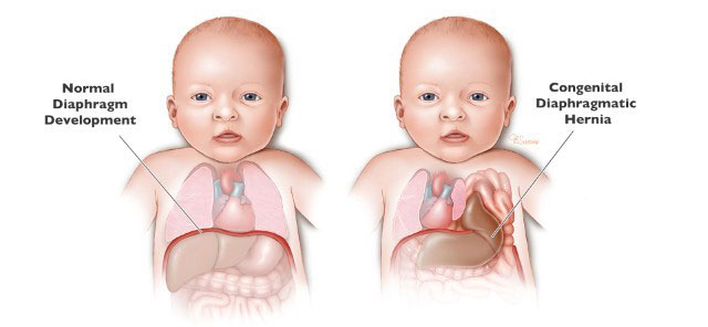 Hình 1. Hình ảnh mô tả trẻ bình thường và trẻ có thoát vị cơ hoành