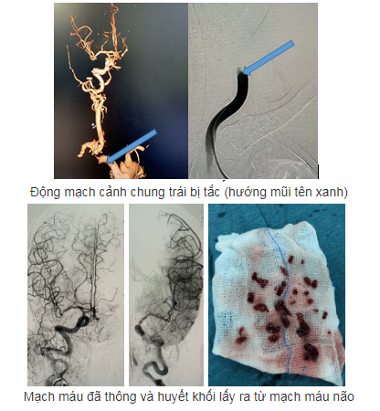 Mạch máu đã thông và huyết khối lấy ra từ mạch máu não