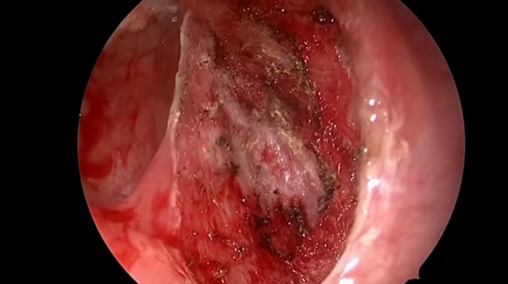 Hình ảnh: Hốc mổ sau cắt amidan bằng dao plasma