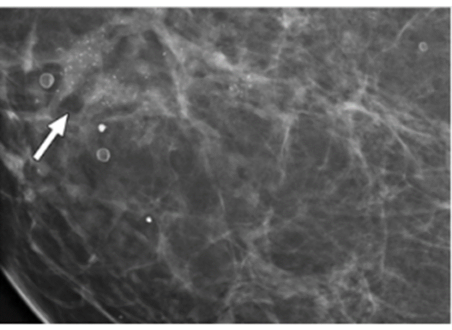 Khối mờ có nhiều nốt vi vôi hoá không đồng nhất, gián đoạn: nghi ngờ ung thư vú