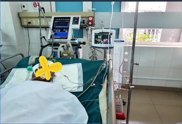 Bệnh nhân xuất huyết não thất được đặt EVD và bơm tiêu sợi huyết