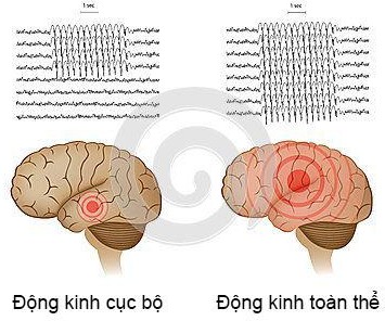 Dạng EEG của bệnh nhân động kinh