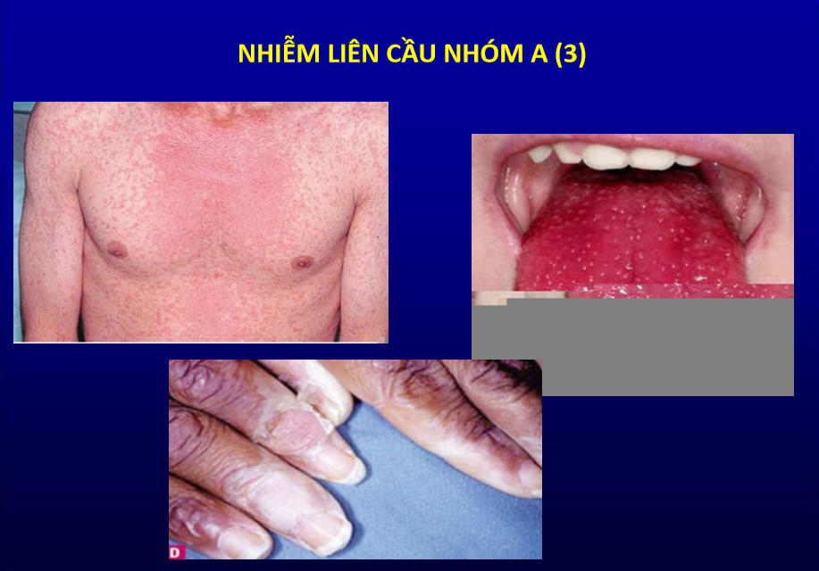 Nhiễm trùng do liên cầu
