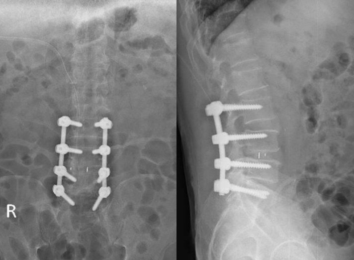 Hẹp ống sống thắt lưng