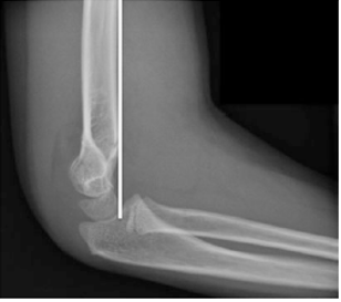 Hình 2: Gãy trên lồi cầu xương cánh tay Gartland độ IIA , đầu gãy xa duỗi so với đường trước xương cánh tay (đường trắng). Ở những trường hợp khuỷu không tổn thương ở trẻ trên 4 tuổi, đường trước xương cánh tay đi qua 1/3 giữa lồi cầu ( Courtesy of Joshua M. Abzug, MD)