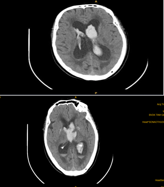 CT sọ não trước đặt EVD