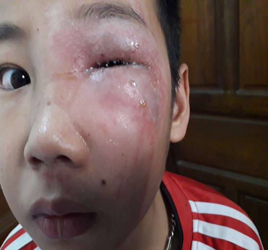 Viêm da tiếp xúc do kiến ba khoang