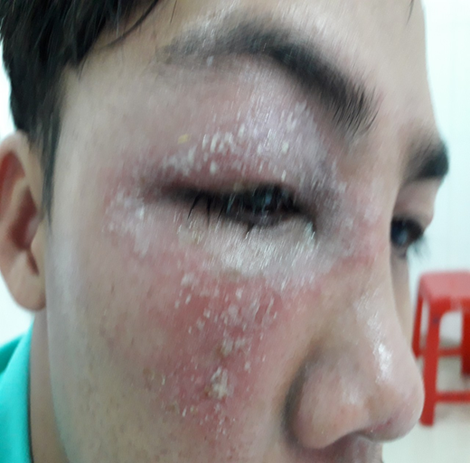 Viêm da tiếp xúc do kiến ba khoang