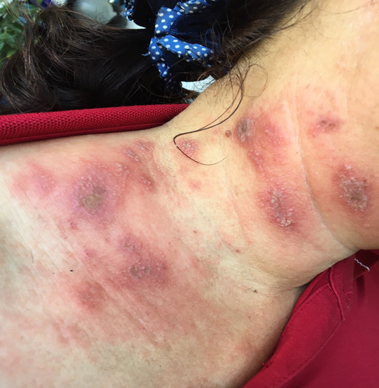 Viêm da tiếp xúc do kiến ba khoang