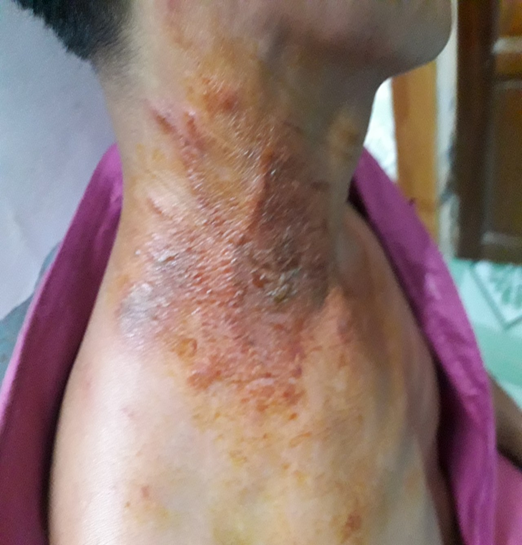 Viêm da tiếp xúc do kiến ba khoang