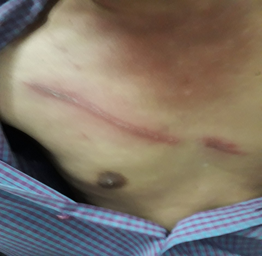 Viêm da tiếp xúc do kiến ba khoang