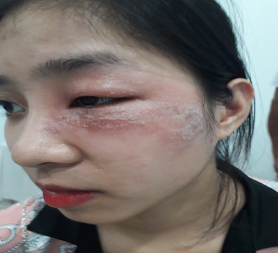 Viêm da tiếp xúc do kiến ba khoang