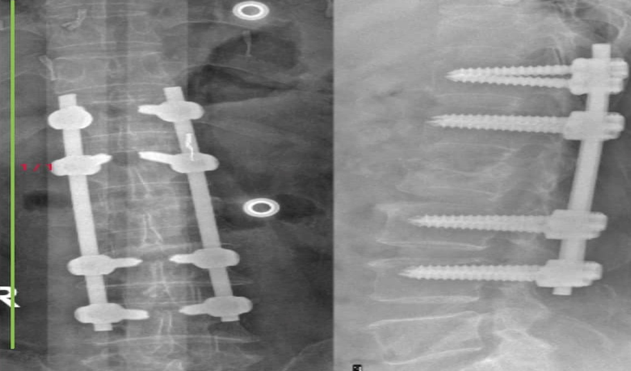 MRI của Bệnh nhân thoát vị đĩa đệm - hẹp ống sống, được điều trị bằng phương pháp Phẫu thuật tại bệnh viện đa khoa tỉnh Quảng Trị  