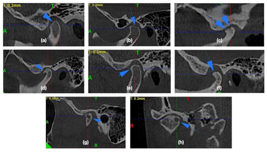 Cone Beam Ct & Những Ứng Dụng Trong Chuyên Ngành RHM