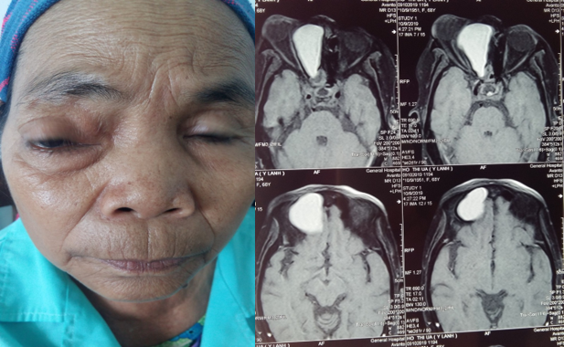 Hình ảnh lâm sàng và MRI của 1 bệnh nhân u nhầy xoang sàng, có biến chứng lồi mắt- Được chẩn đoán và điều trị phẫu thuật tại bệnh viện đa khoa tỉnh Quảng Trị 