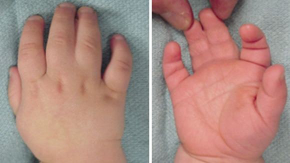 Hình 1: Dính ngón 3-4 đơn thuần