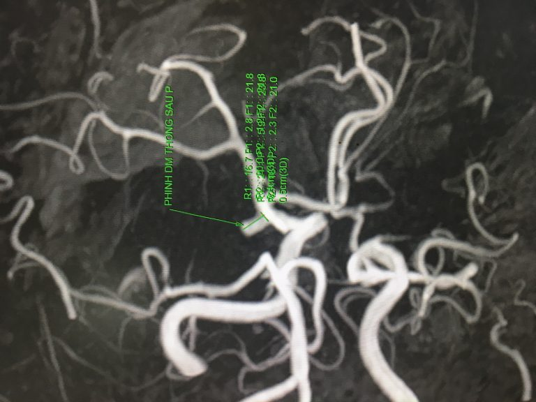 Phát hiện phình mạch ở bênh nhân đau đầu khi chụp MRI (không tiêm thuốc).