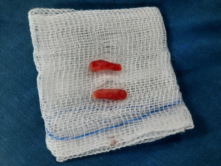 Mỏm trâm của bệnh nhân B đã được cắt bỏ