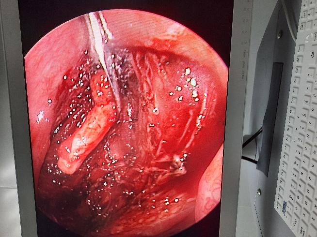 Bộc lộ mỏm trâm của bệnh nhân B.