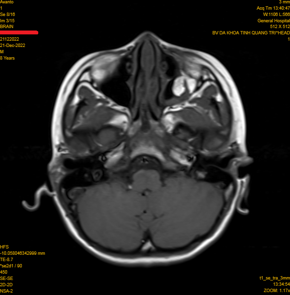 Vỡ thành hốc mắt