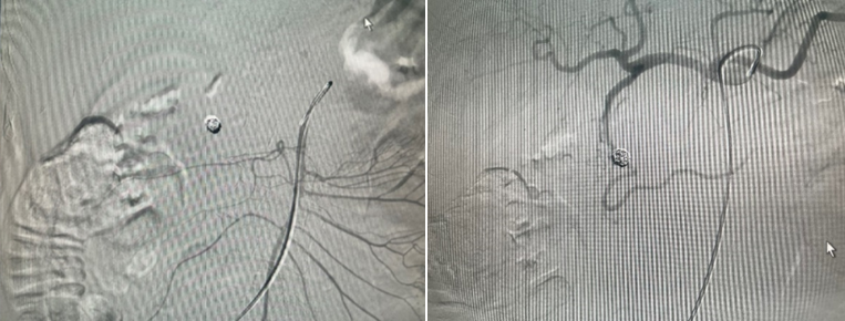 Hình 7 và 8. Chụp mạch sau can thiệp